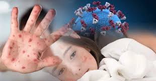 হামের ভয়াবহতা বাড়ছেই: ২৩ দিনে ১৪৯ শিশুর মৃত্যু